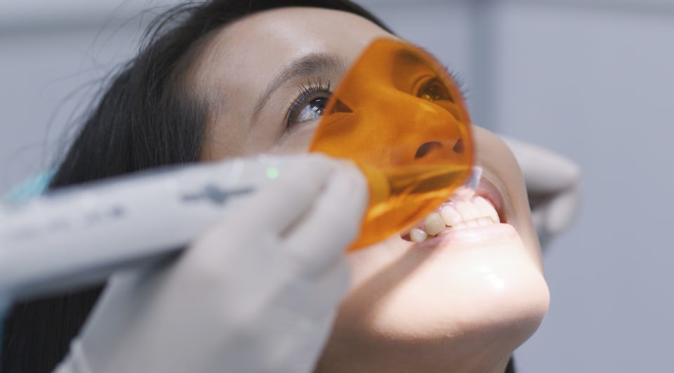 Composite Veneers Emu Plains 