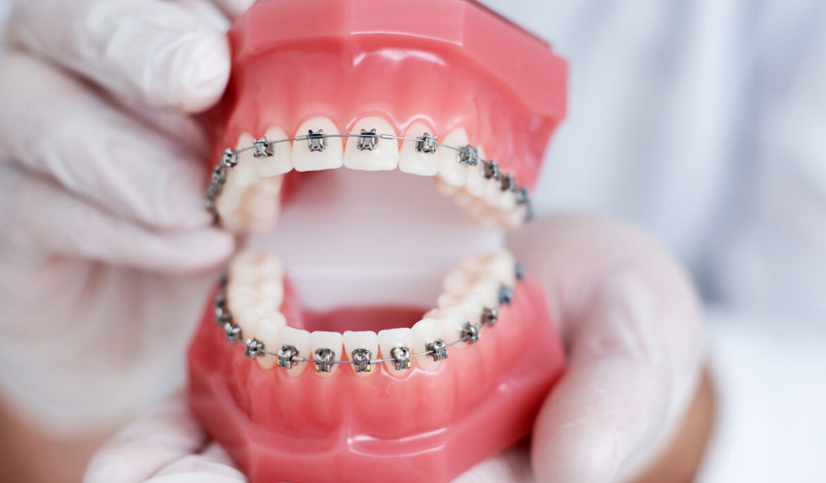 braces