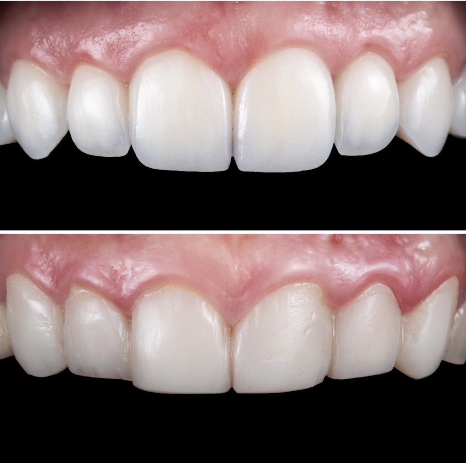 Smile Makeover Emu Plains 