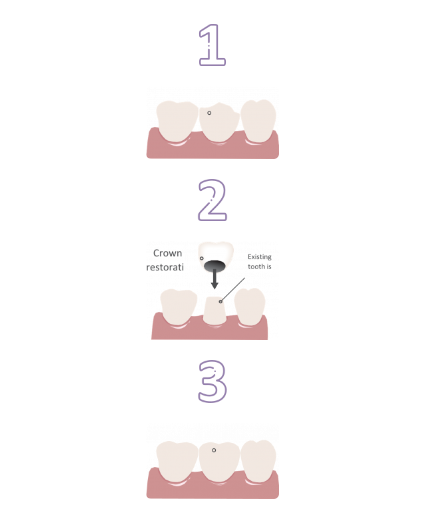 Diagram showing dental crown procedure in three steps: 1) Tooth before crown, 2) Fitting crown, 3) Tooth with crown. Labels indicate process stages.