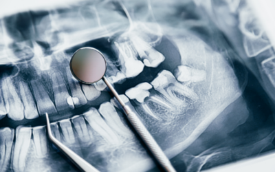 Wisdom Teeth and Crowded Teeth: Understanding the Connection