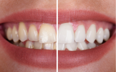 Before and After: Real Transformations Through Cosmetic Dentistry
