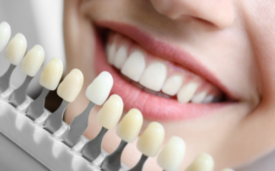 Teeth Whitening Options: Which One Is Right for You?