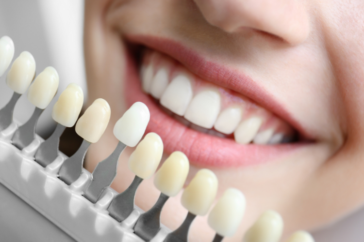 Teeth Whitening Options: Which One Is Right for You?
