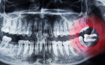 Do All Wisdom Teeth Need to Be Removed? What Dentists Recommend