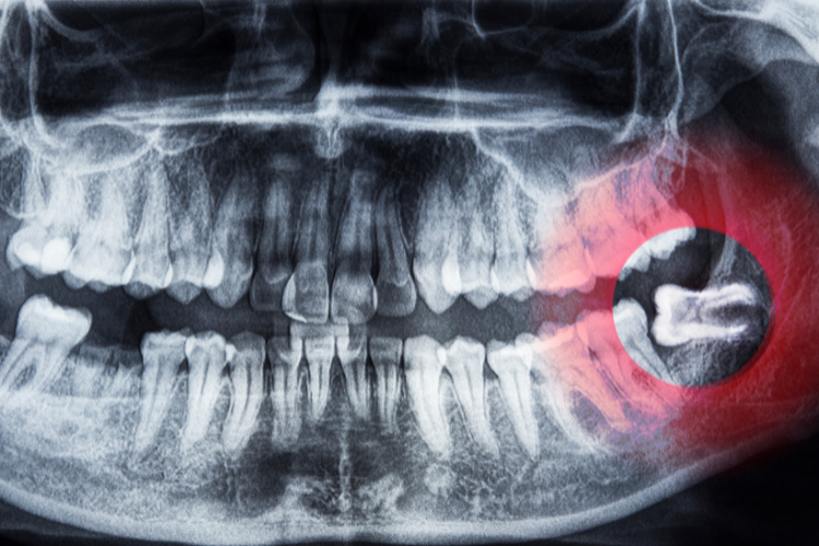 A dental X-ray showing a full set of teeth with a highlighted wisdom tooth on the right. The tooth appears impacted, partially angled into the jaw.