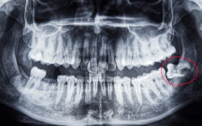 How to Prepare for Wisdom Teeth Removal Surgery
