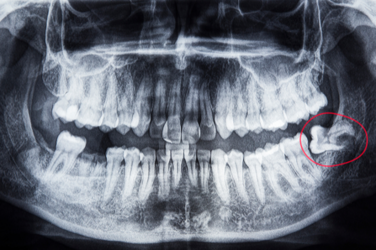 How to Prepare for Wisdom Teeth Removal Surgery Dental X-ray showing a full set of teeth, with an impacted wisdom tooth circled in red on the lower right side. The image has a clinical tone.