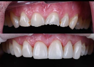 Close-up comparison of two rows of upper teeth. The top row shows worn and chipped teeth, while the bottom row displays smooth, repaired teeth. Tone: restorative.