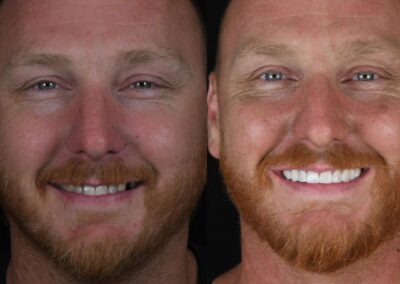 Side-by-side comparison of a man showing his teeth before and after dental work. Left: uneven teeth, neutral expression. Right: bright, even teeth, happy expression.