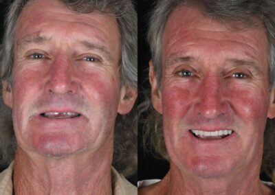 Side-by-side images of an older man showing a transformation. Left: worn teeth, slight frown. Right: bright smile, enhanced teeth, happier expression.