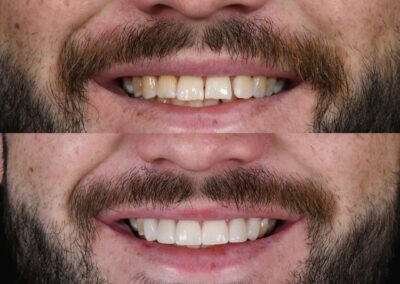 Close-up of a man's mouth showing before and after dental treatment. Top image: stained teeth. Bottom image: whitened, even teeth.