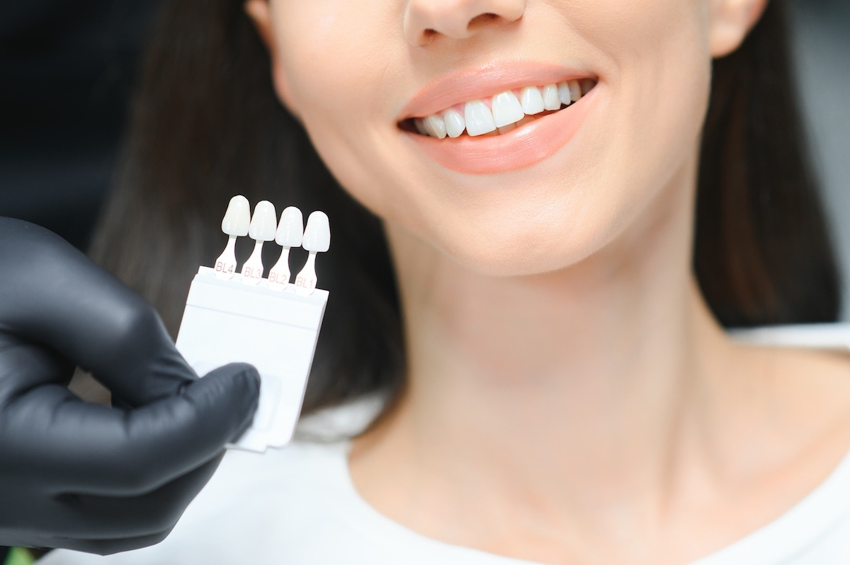 Porcelain Dental Veneers Emu Plains 
