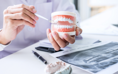 Everything You Need to Know About Implant Supported Dentures
