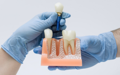 Are Full Mouth Dental Implants Right for You?