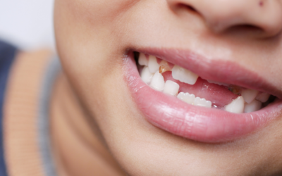 Loose Baby Tooth Care: What Parents in Emu Plains Should Know