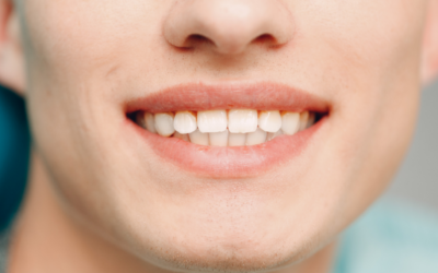 Life After Braces or Invisalign: How to Keep Your Smile Straight