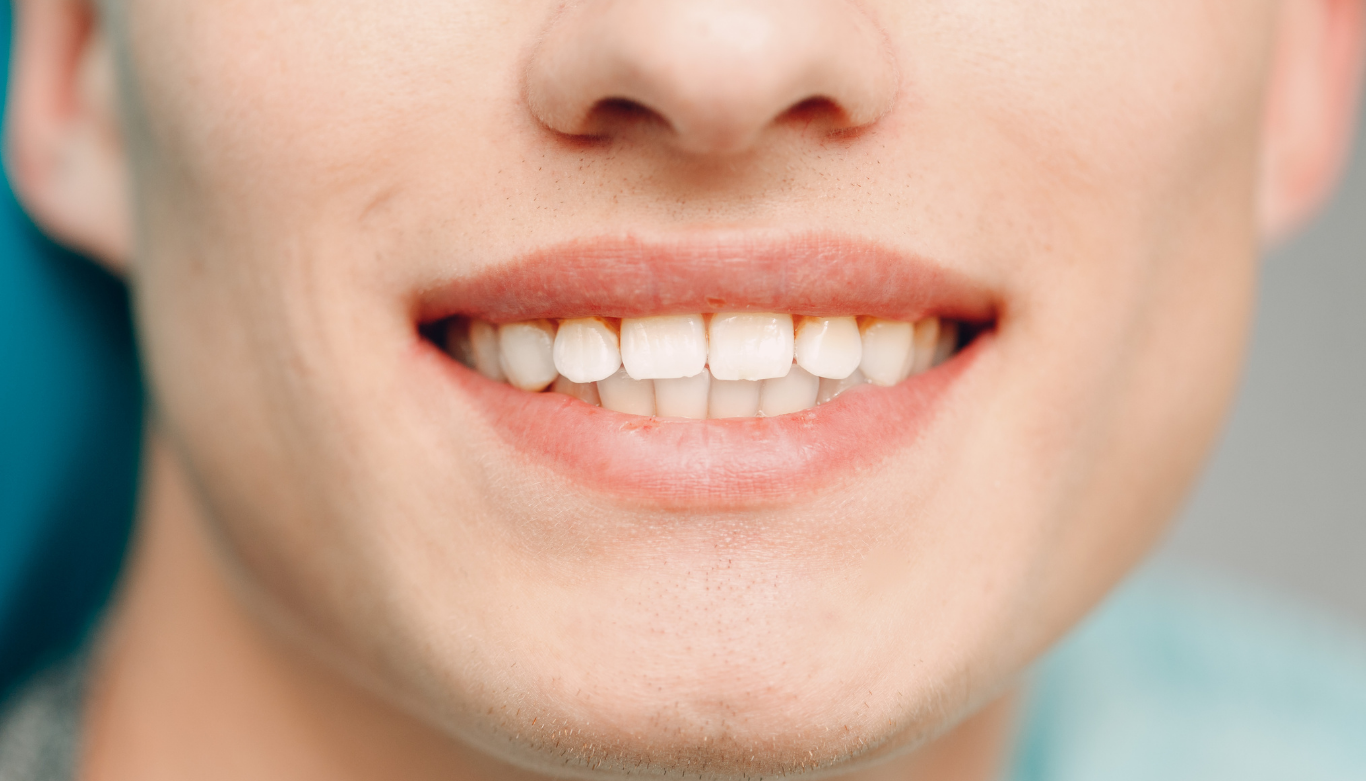emu-plains-family-dental-keep-smile-straight Close-up of a smiling mouth with visible white teeth and pink lips.